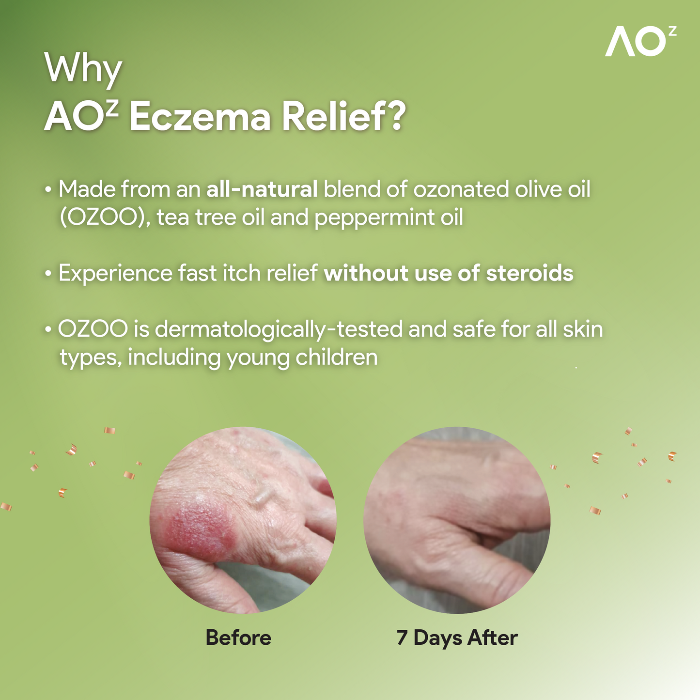 Eczema Support Bundle