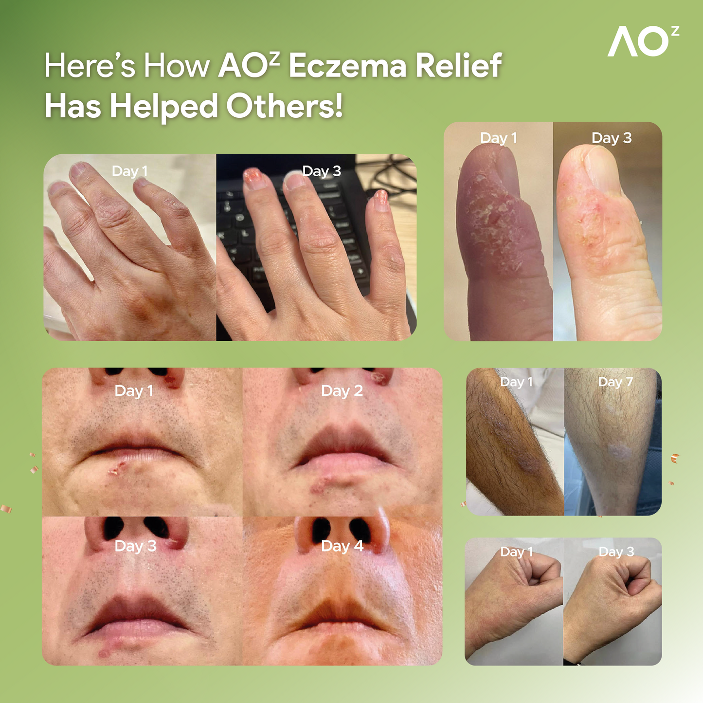 Eczema Relief